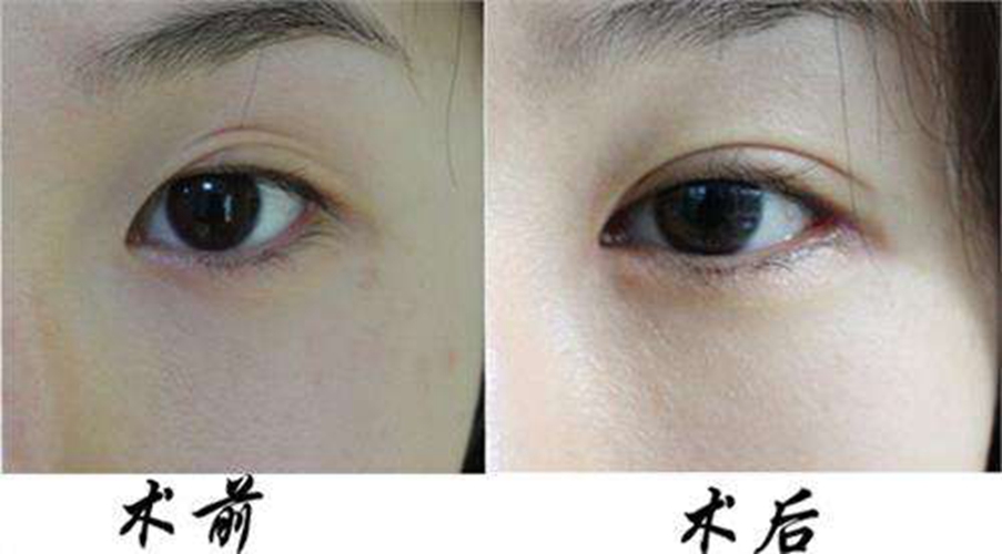 最新雙眼皮技術(shù)，無需開刀，遠(yuǎn)離埋線
