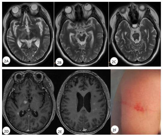 運(yùn)動(dòng)神經(jīng)元病最新治療方案研究