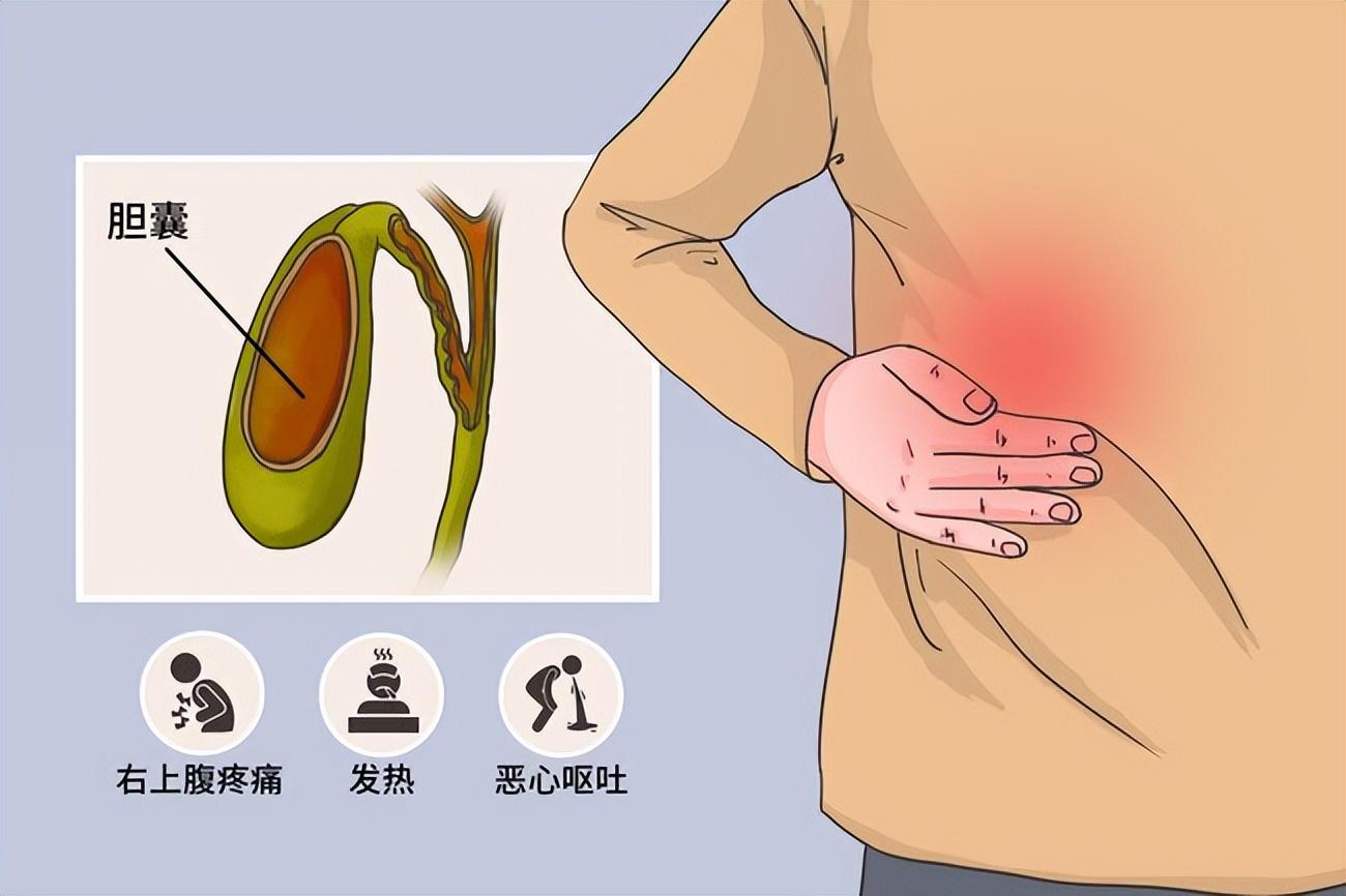 膽結(jié)石最新療法，探索與創(chuàng)新的治療手段